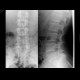 Spina bifida: X-ray - Plain radiograph